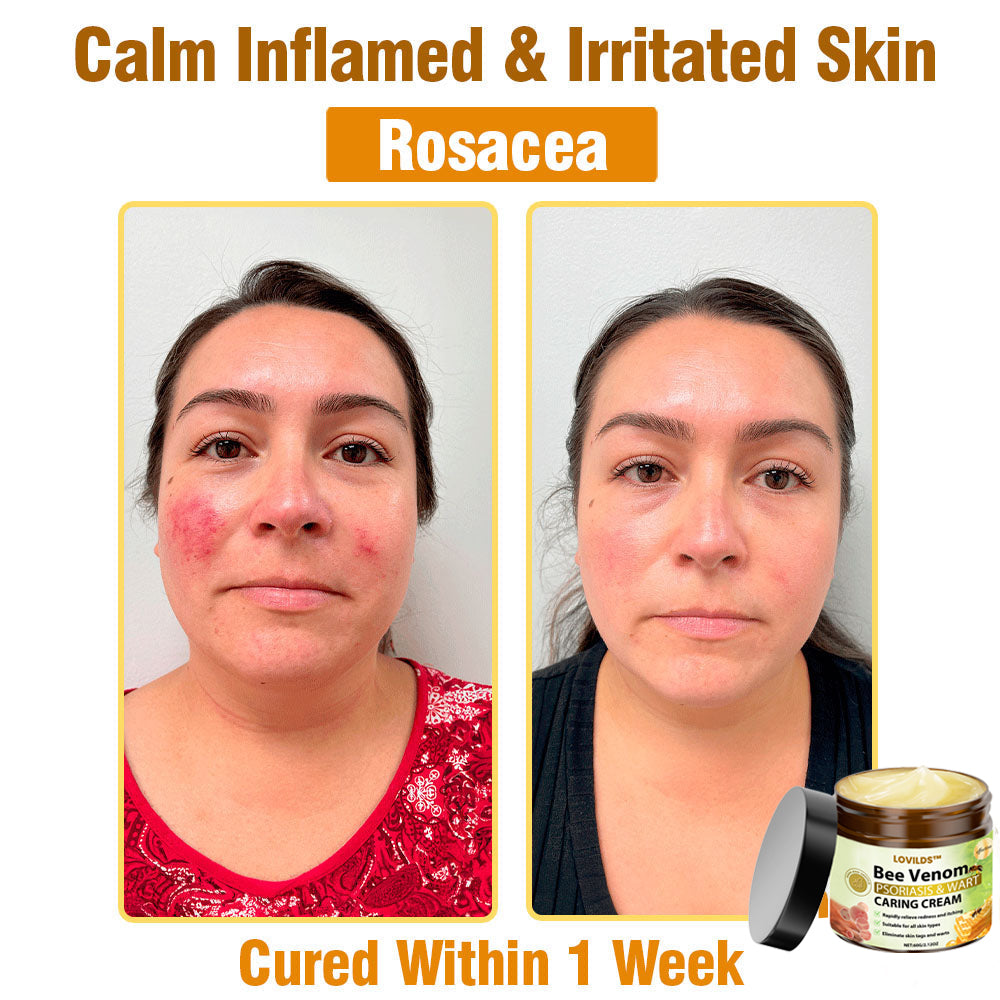 LOVILDS™🐝 Bee Venom All-in-One Cream US Dermatologist Approved🐝