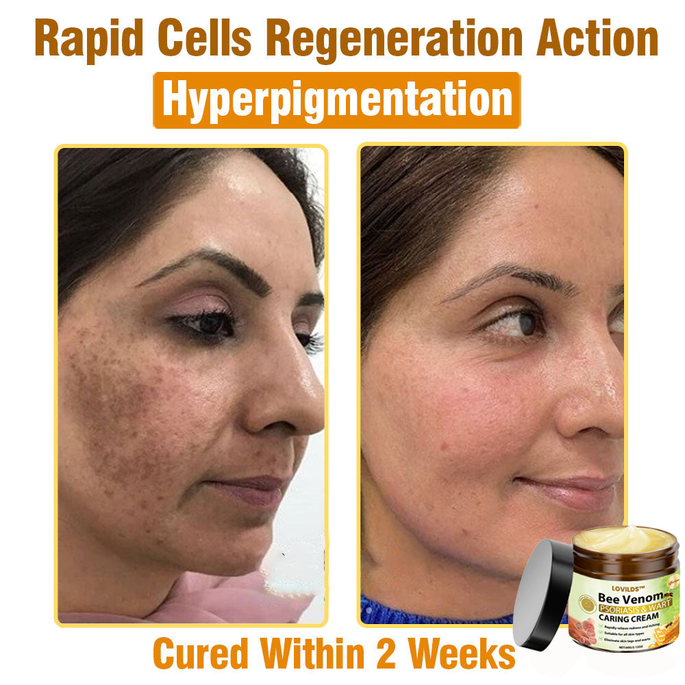 LOVILDS™🐝 Bee Venom All-in-One Cream US Dermatologist Approved🐝