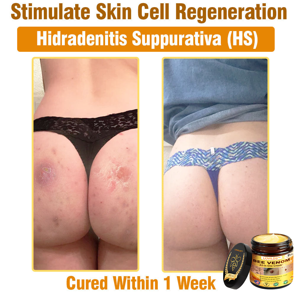 LOVILDS™ Bee Venom All-in-One Cream US Dermatologist Approved🐝🐝