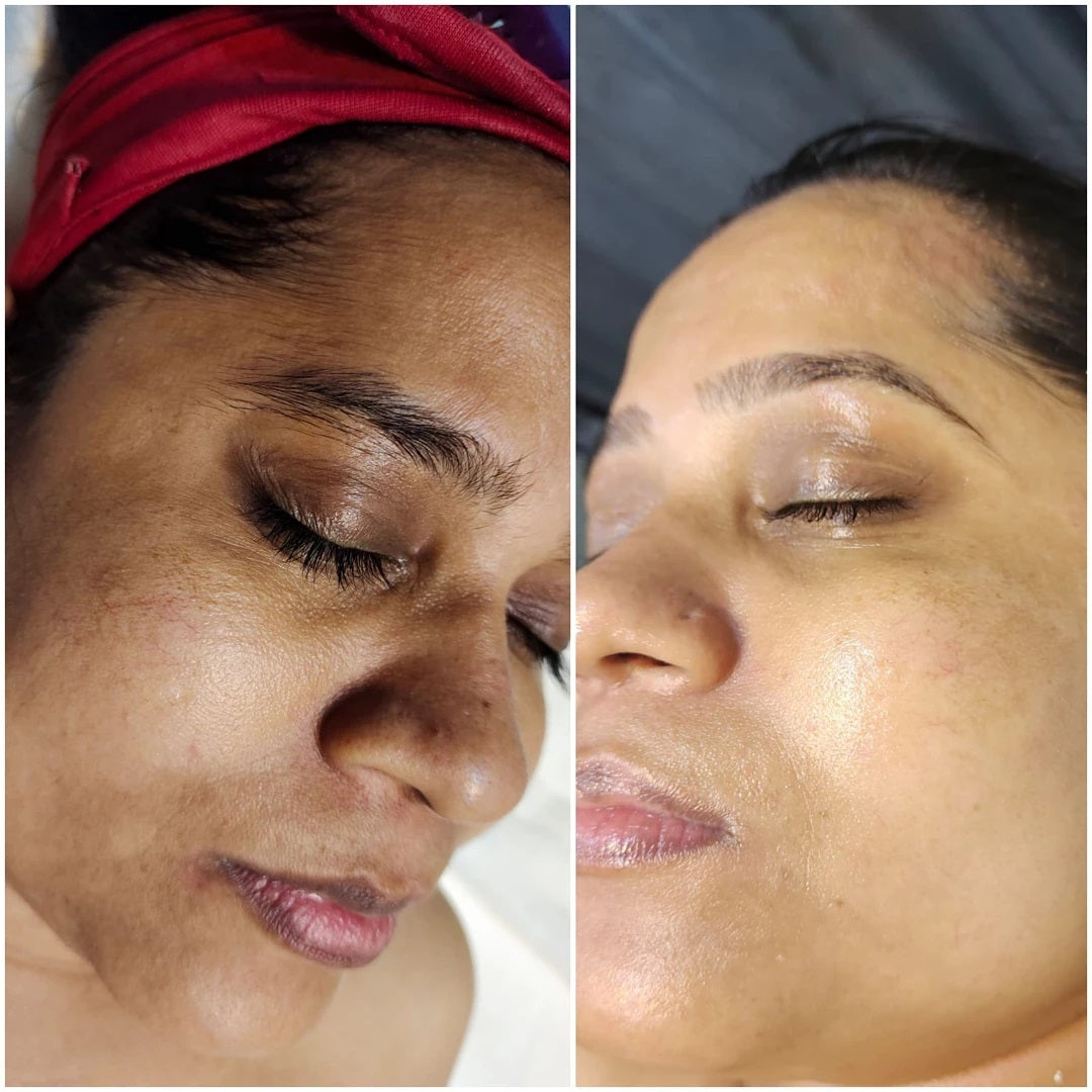 (🔥LAST DAY SALE-80% OFF)-Fast Dark Spot Remover-NESLEMY™ Turmeric Spot Repair Serum