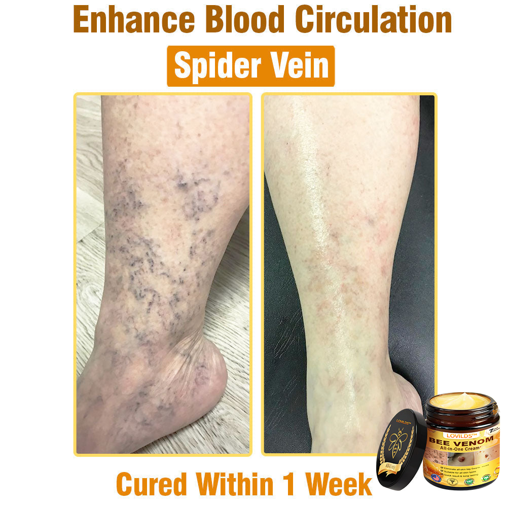LOVILDS™ Bee Venom All-in-One Cream US Dermatologist Approved🐝🐝