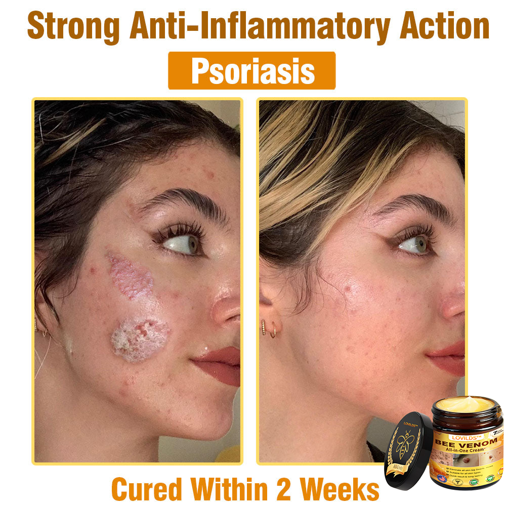 LOVILDS™ Bee Venom All-in-One Cream US Dermatologist Approved🐝🐝