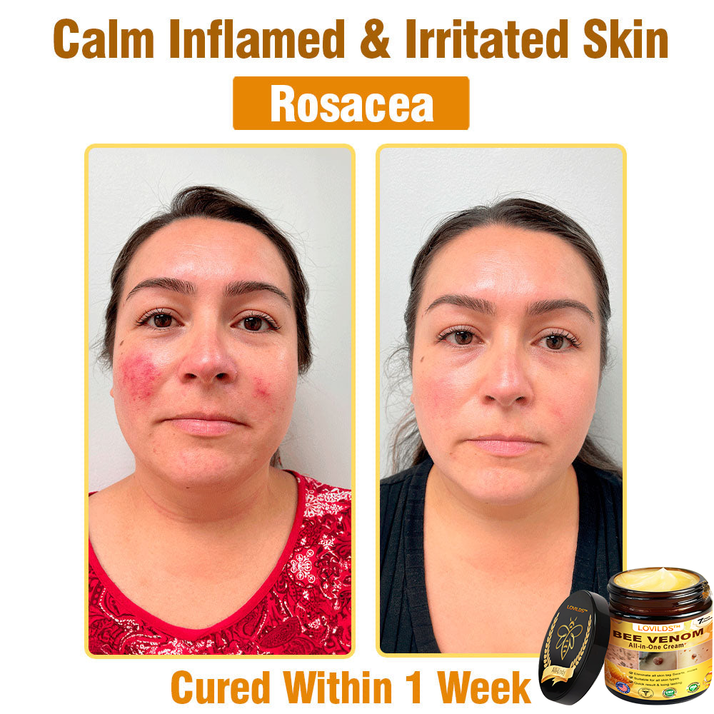 LOVILDS™ Bee Venom All-in-One Cream US Dermatologist Approved🐝🐝
