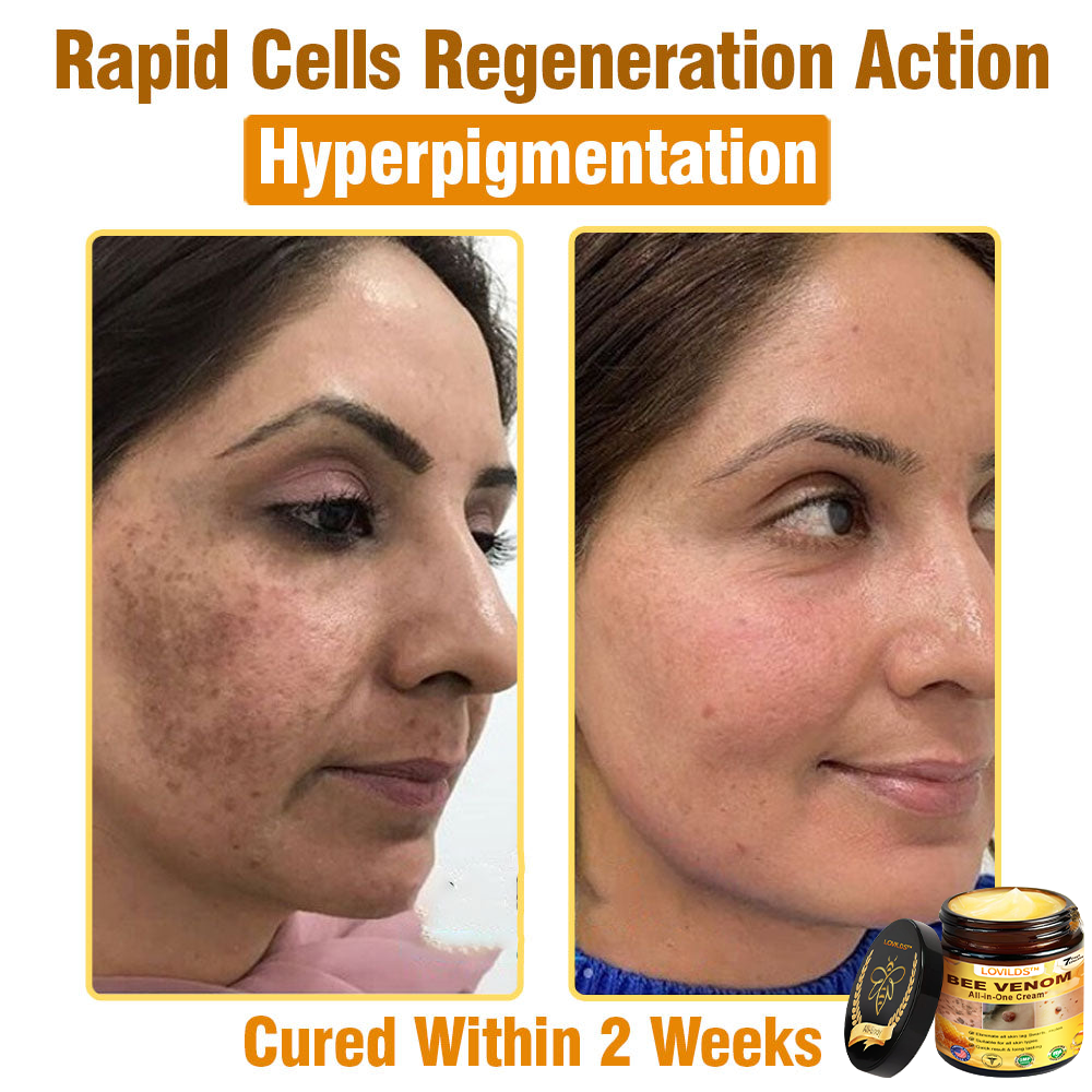LOVILDS™ Bee Venom All-in-One Cream US Dermatologist Approved🐝🐝