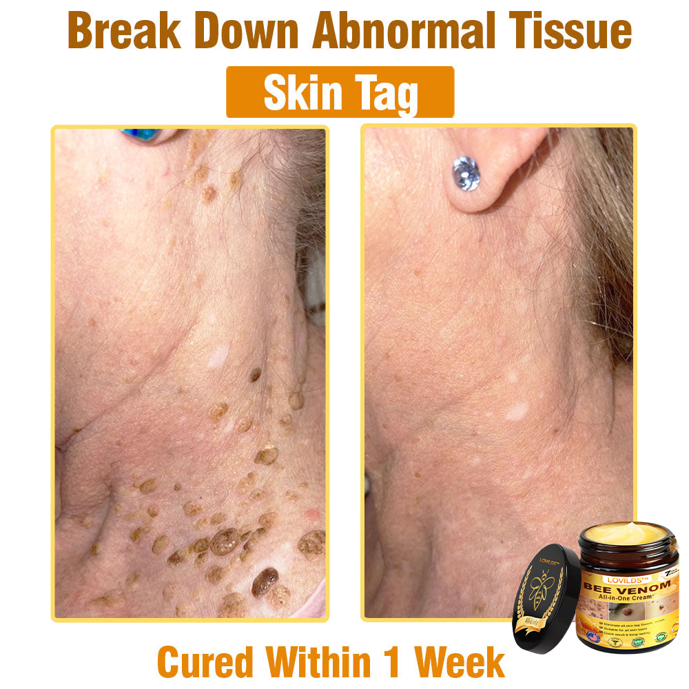 LOVILDS™ Bee Venom All-in-One Cream US Dermatologist Approved🐝🐝
