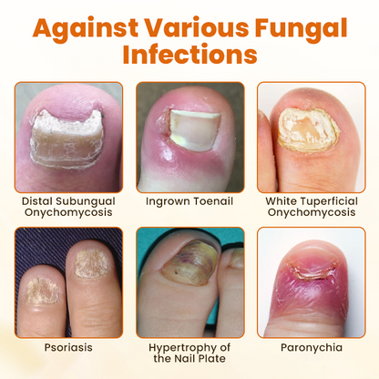 Medazy™ Fungi Bee Advanced Nail Repair Spray