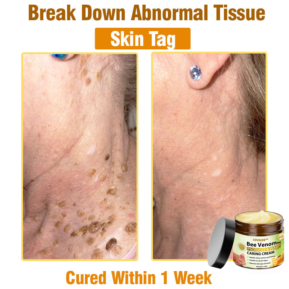 LOVILDS™🐝 Bee Venom All-in-One Cream US Dermatologist Approved🐝